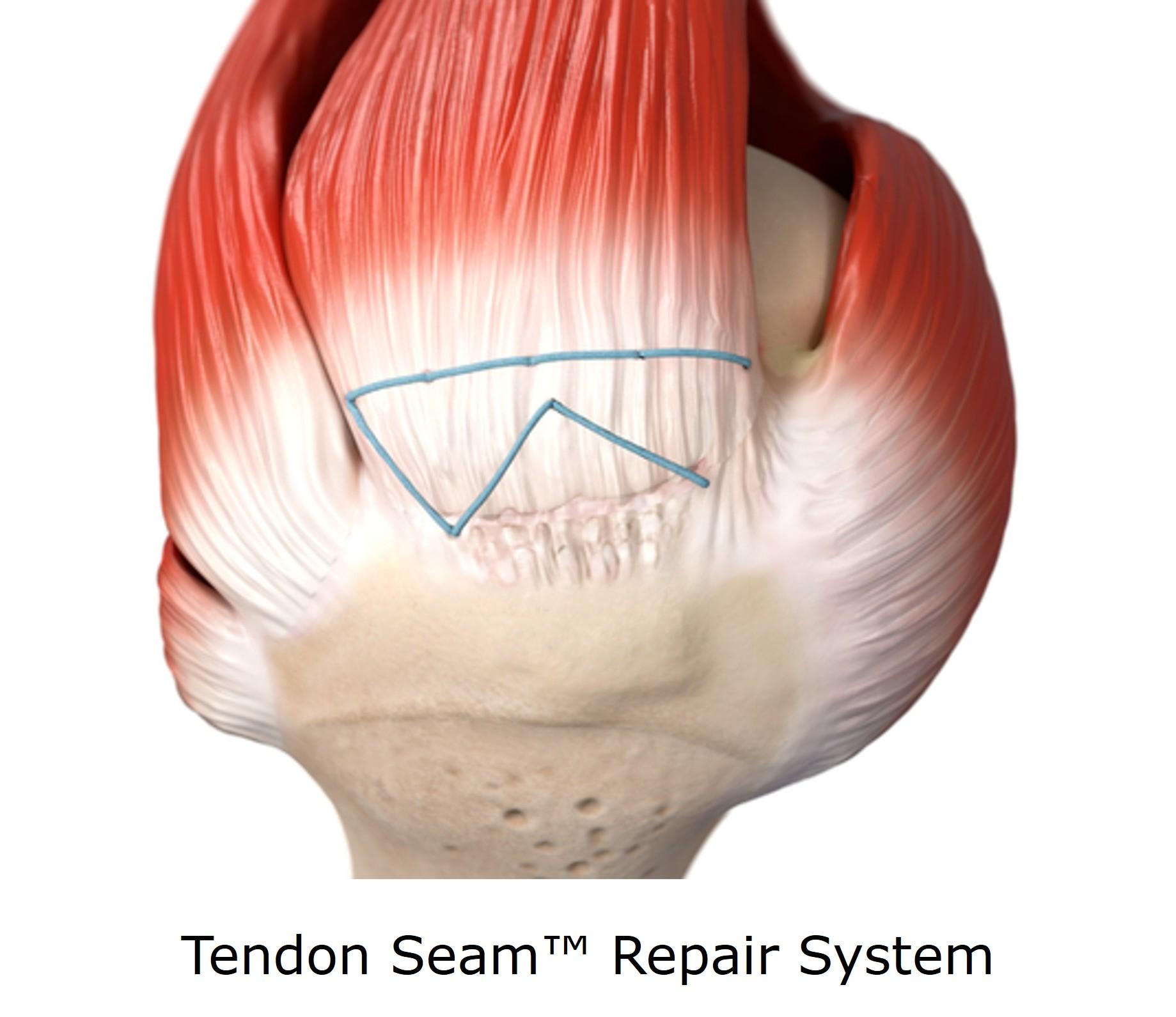 Smith+Nephew to feature leading rotator cuff repair portfolio including new Tendon Seam Repair System and REGENETEN◊ Bioinductive Implant at AAOS 2026